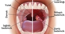 Bademcik İltihabı Nasıl Geçer