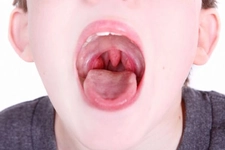 Bademcik İçin Antibiyotik Kullanımı ve Faydaları Nelerdir?