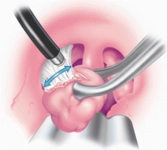 Bademcik Aldırma Nedir ve Nasıl Yapılır?