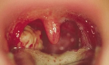 Bademcik Düşmesi Belirtileri ve Tedavisi