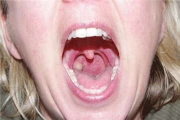 Lazerle Bademcik Ameliyatı